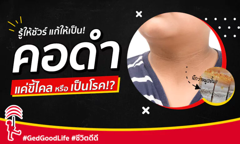 รู้ให้ชัวร์ แก้ให้เป็น! “คอดำ” แค่ขี้ไคล หรือเป็นโรคกันแน่!? พร้อมวิธีแก้ให้หายดำ