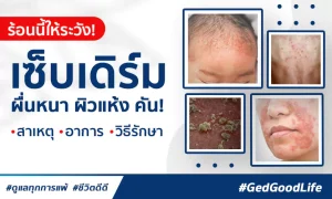 อากาศร้อนให้ระวัง! “โรคเซ็บเดิร์ม” ผื่นหนา ผิวแห้ง คัน : สาเหตุ อาการ วิธีรักษา