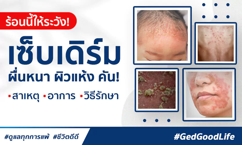 อากาศร้อนให้ระวัง! “โรคเซ็บเดิร์ม” ผื่นหนา ผิวแห้ง คัน : สาเหตุ อาการ วิธีรักษา