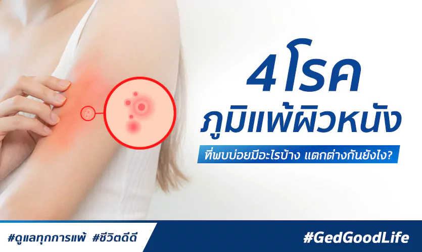 4 โรคภูมิแพ้ผิวหนังที่พบบ่อย มีอะไรบ้าง แตกต่างกันยังไง?