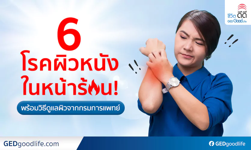 6 โรคผิวหนังหน้าร้อน ที่คนไทยต้องระวัง! พร้อม 10 วิธีดูแลผิวหนังโดยกรมการแพทย์