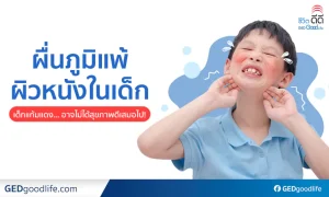 ไขข้อข้องใจ! โรคผื่นภูมิแพ้ผิวหนังในเด็ก เกิดจากอะไร รักษายังไงดี?