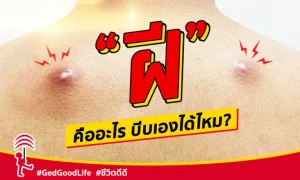 ฝี คืออะไร ใช่สิวหรือไม่ บีบเองได้ไหม? มาดูคำตอบ พร้อมสาเหตุ อาการ วิธีรักษา