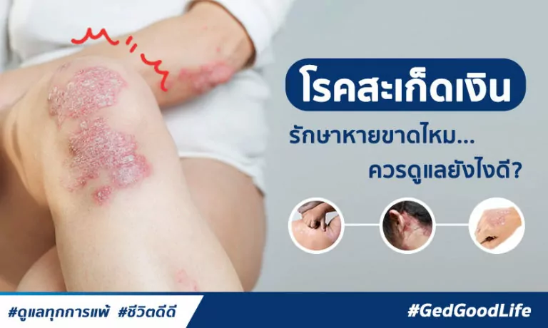 โรคสะเก็ดเงิน เกิดจากอะไร มีโอกาสหายขาดไหม ควรรักษา ดูแลยังไงดี?