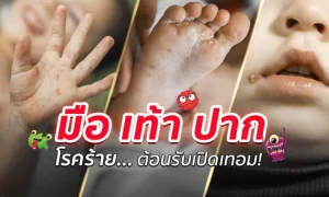 โรคมือเท้าปาก โรคร้ายที่มากับหน้าฝน!