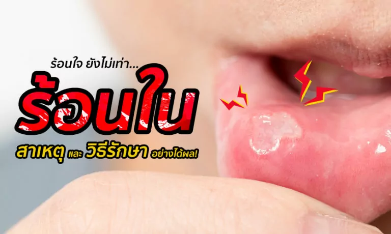 “ร้อนใน” สาเหตุ และวิธีรักษาอย่างได้ผล