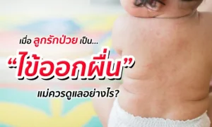 เมื่อลูกรักป่วยเป็น “ไข้ออกผื่น” แม่ควรดูแลอย่างไร?