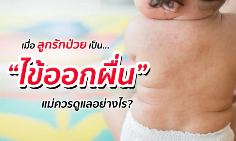 เมื่อลูกรักป่วยเป็น “ไข้ออกผื่น” แม่ควรดูแลอย่างไร?