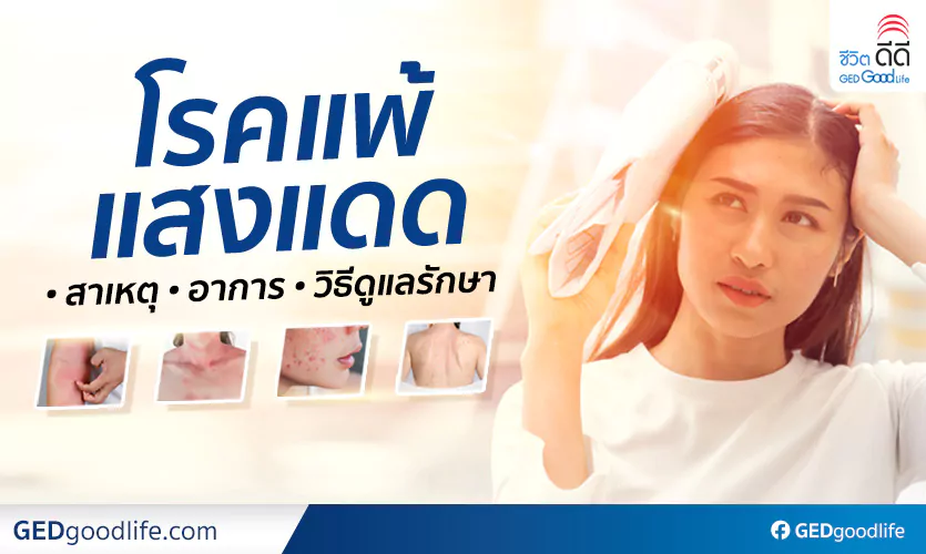 โรคแพ้แสงแดด – สาเหตุ อาการ วิธีรักษา และ 8 วิธีป้องกันจากกรมการแพทย์